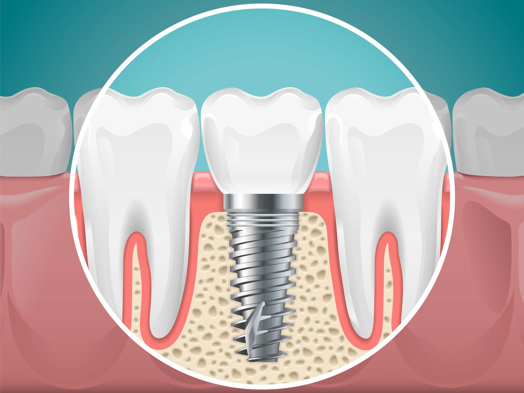 Haddon Oral Surgeons PA Dental Implants NJ